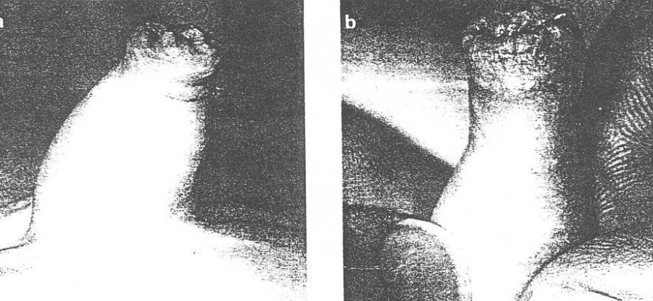 Phimosis: when is circumcision necessary?