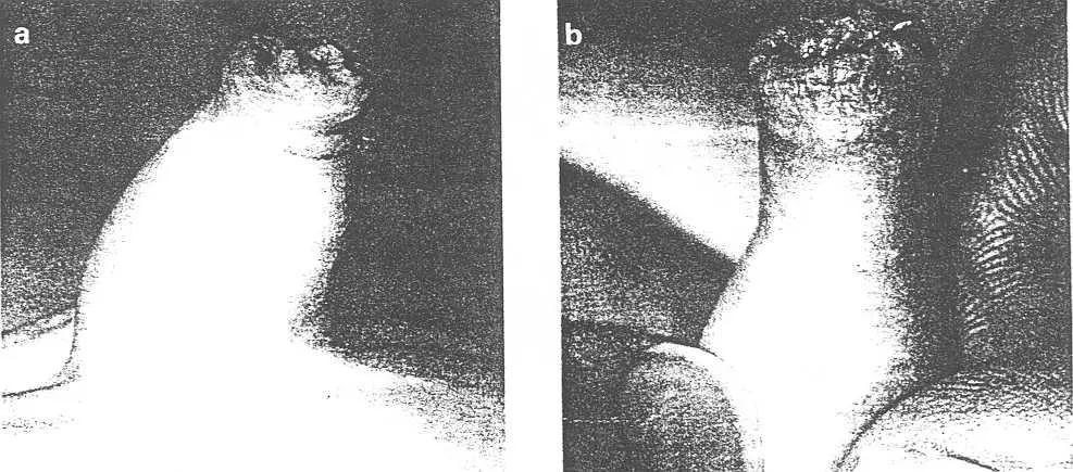 Phimosis: when is circumcision necessary?