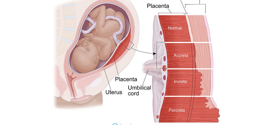 Placenta accreta: pe a leaga le totoina o le placenta