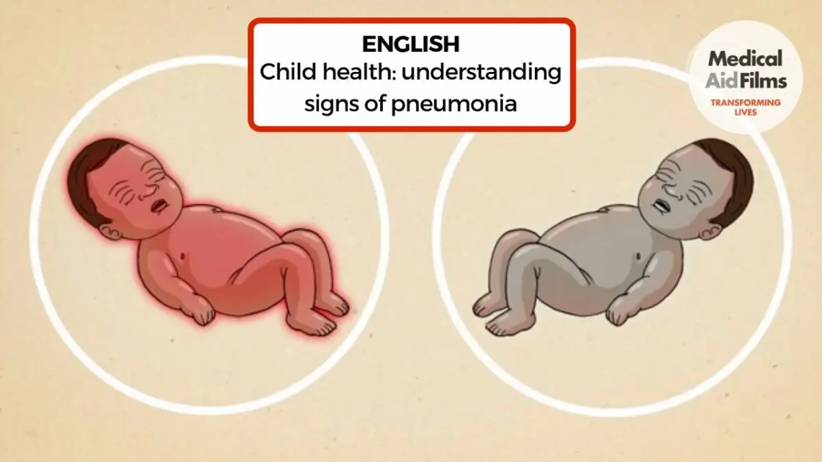 Pneumonia in babies