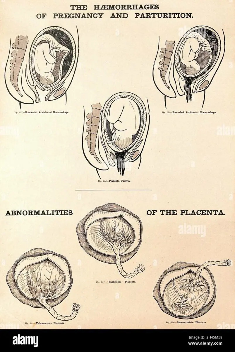 Pregnancy: update on abnormalities of the placenta