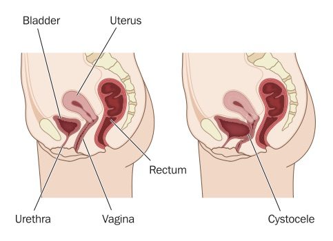 Prolapse: an expert answers you