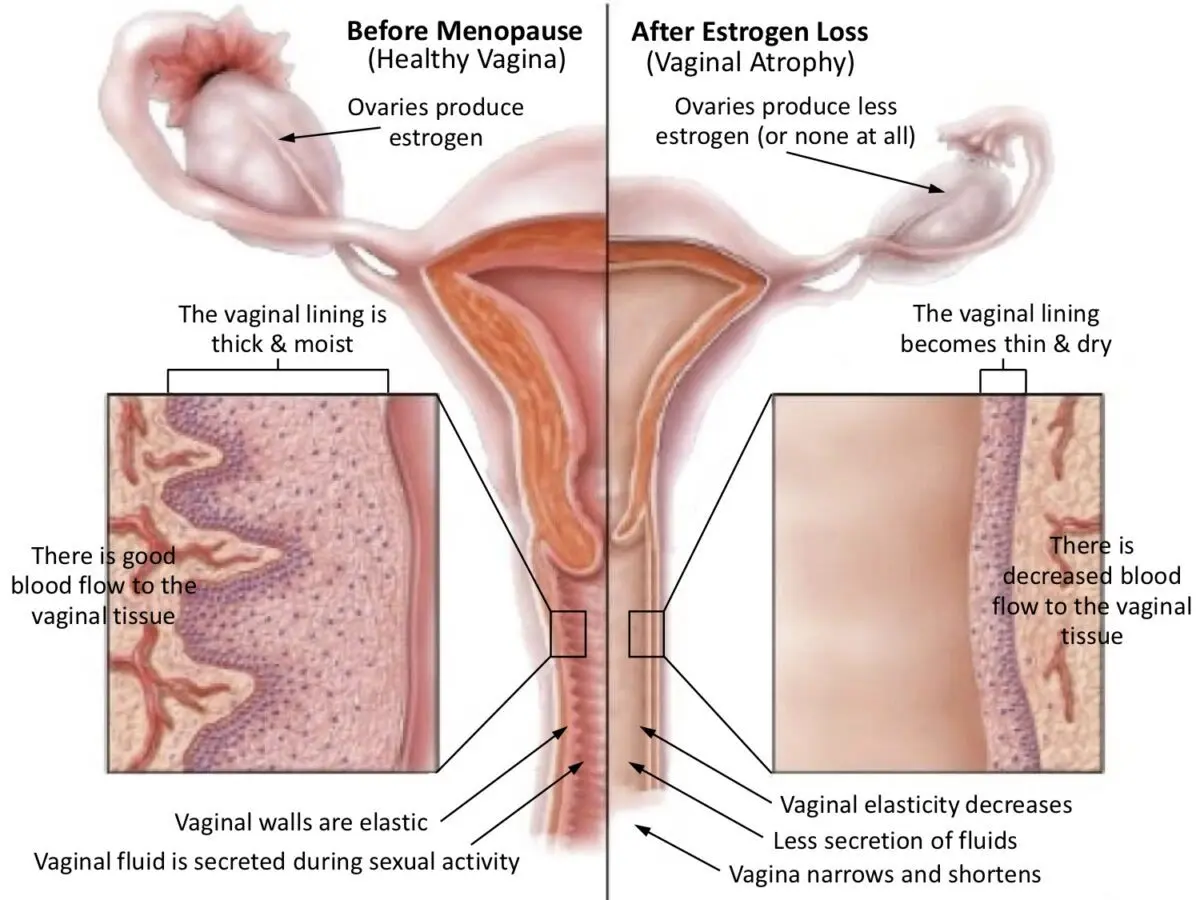 Rejuvenation of the vagina or vulva: what you need to know