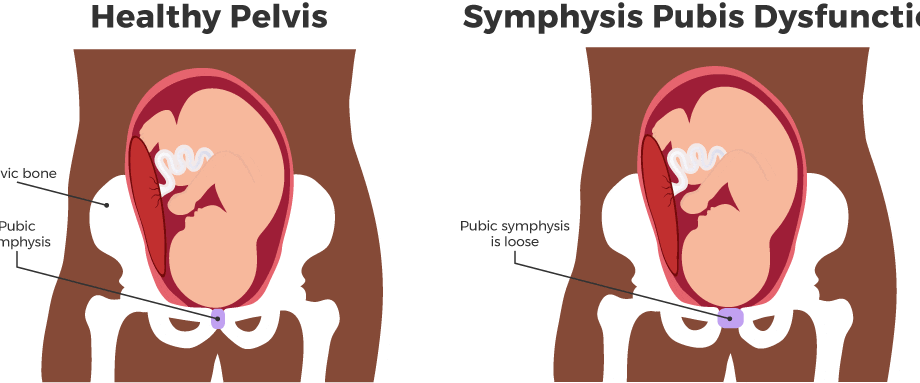 Relieve pubic symphysis during pregnancy