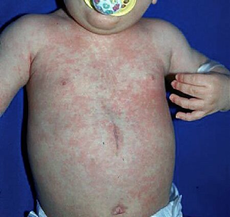 Roseola at Baby