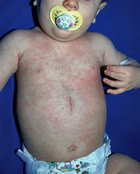 Roseola at Baby