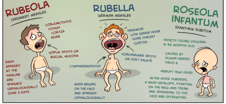 Rubeola dhe roseola tek fëmijët