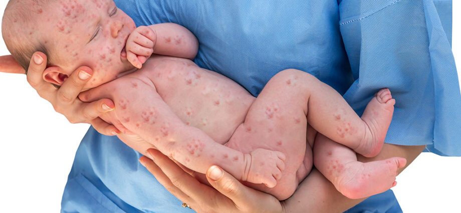 Rubella in babies