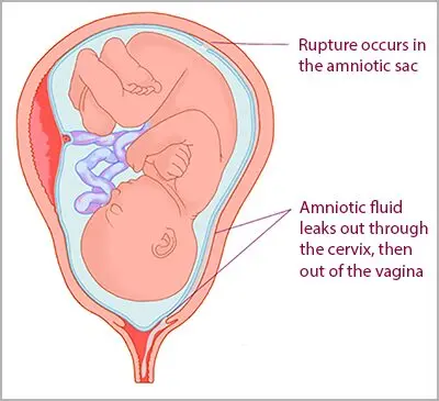 Rupture of the water bag, what to do?