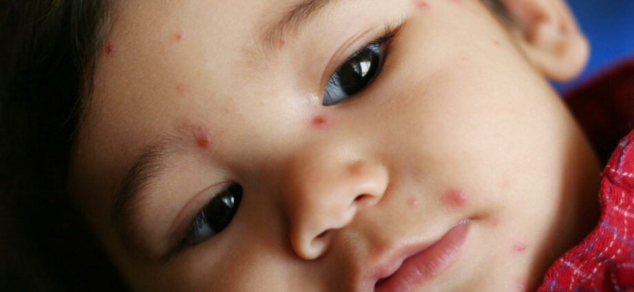 Scabs, plaques and redness in Baby