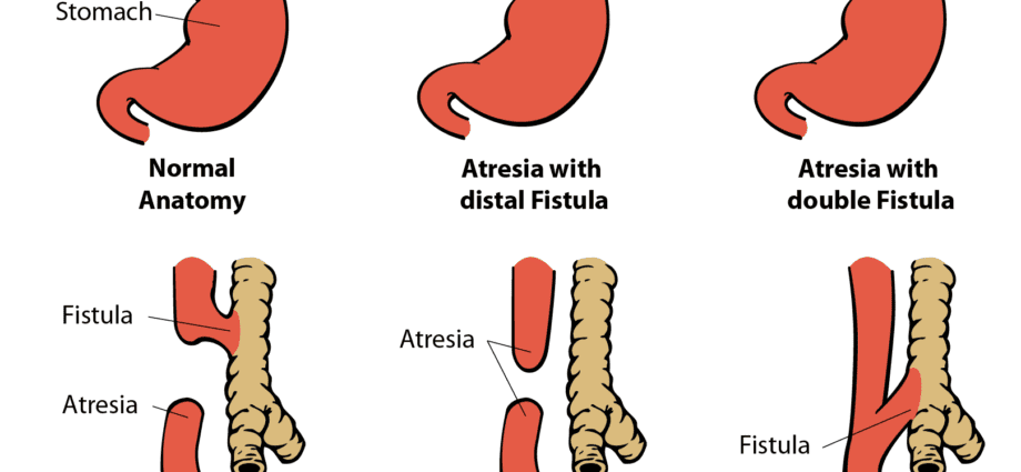 Screen for esophageal atresia