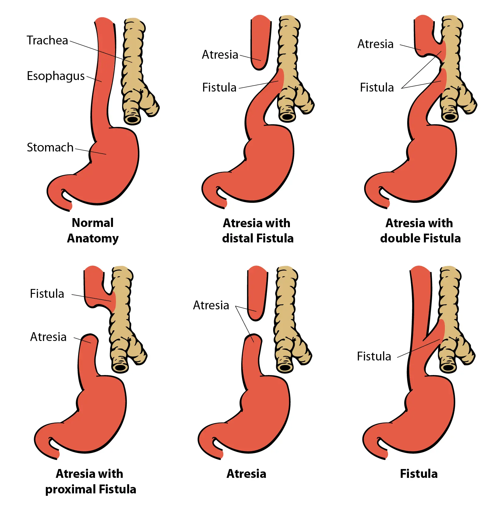 Screen for esophageal atresia