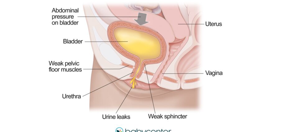 (Väike) uriini lekkimine rasedatel naistel