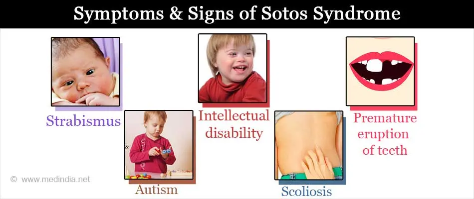 Sotos syndrome: everything you need to know