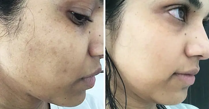 Spots on the skin: how to remove them?