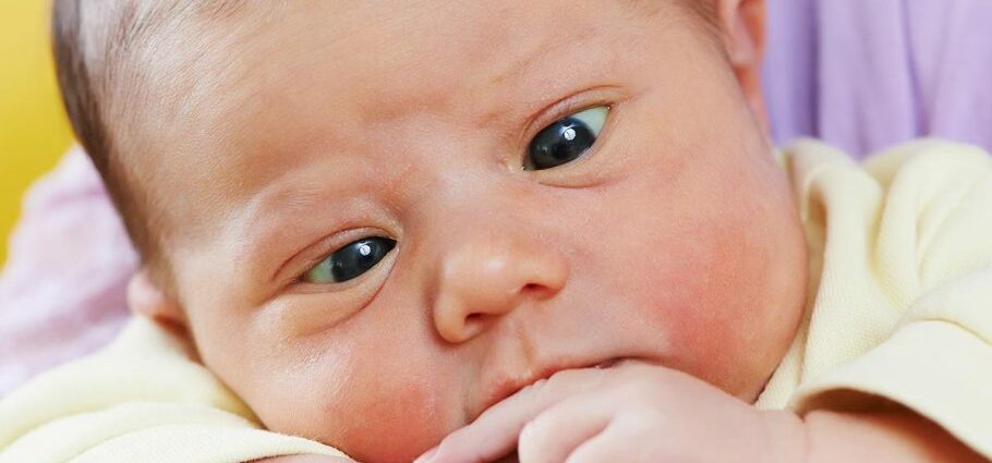 Strabismus in babies