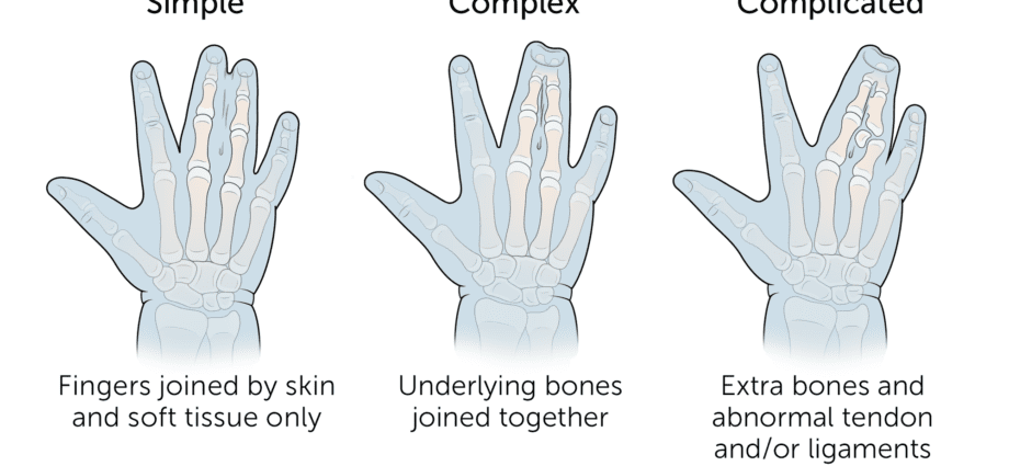 Syndactyly: baby&#8217;s fingers stick together