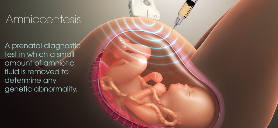 El curso de una amniocentesis
