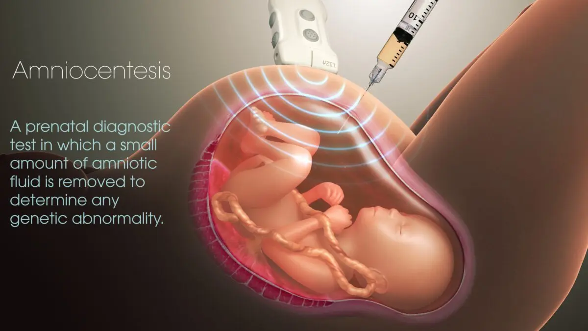 The course of an amniocentesis