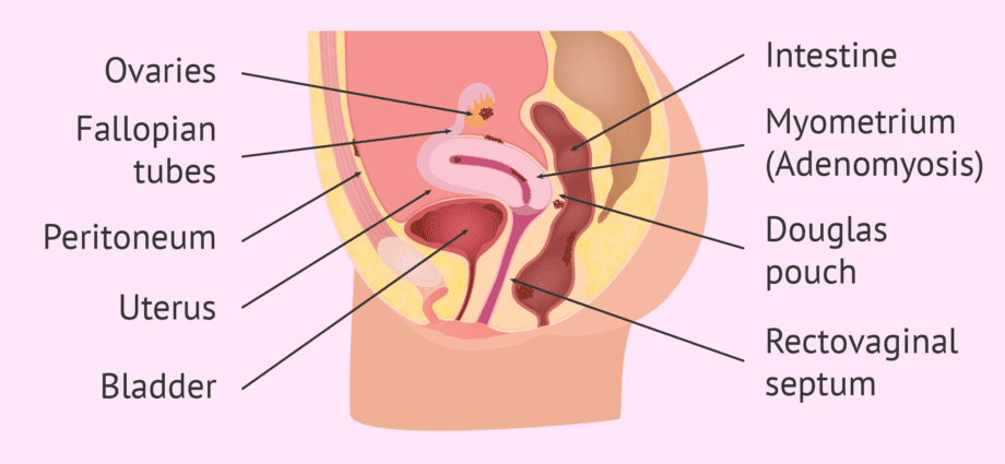 子宫内膜异位症的位置