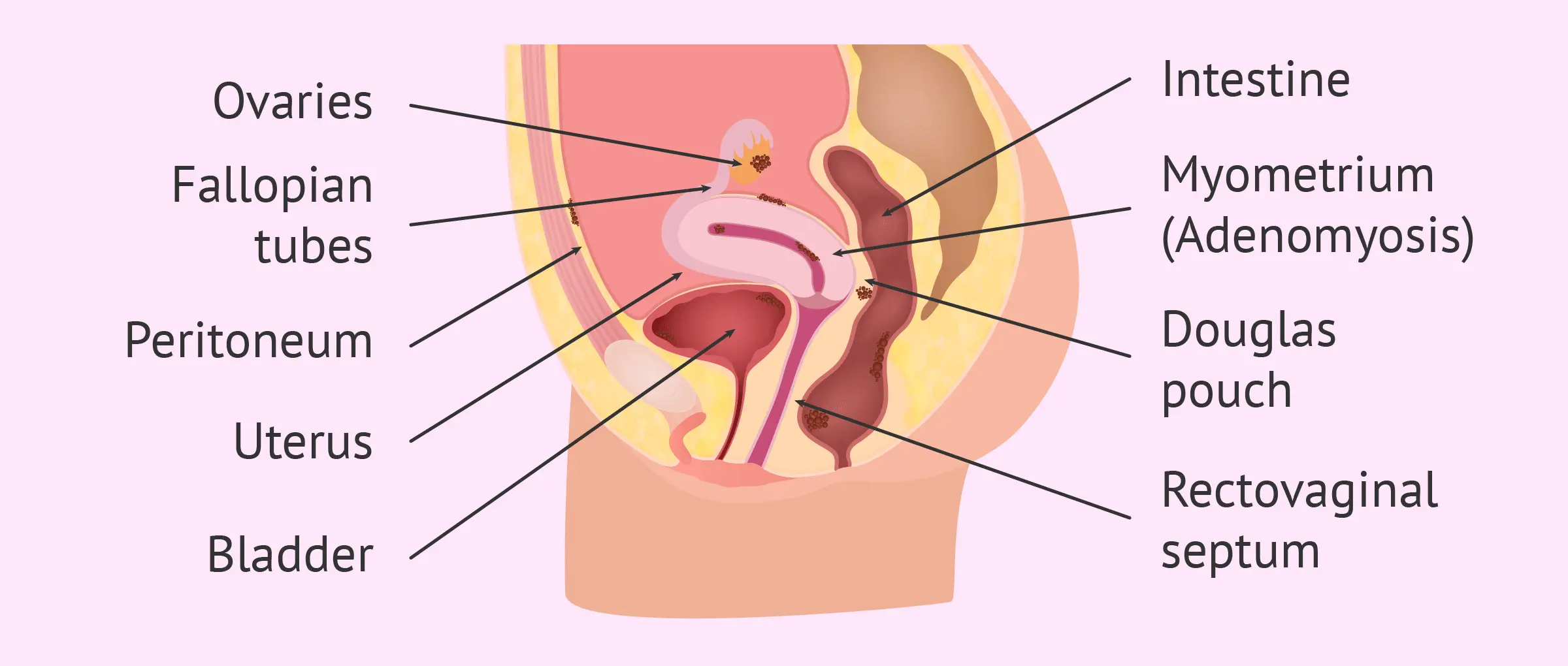 The location of endometriosis