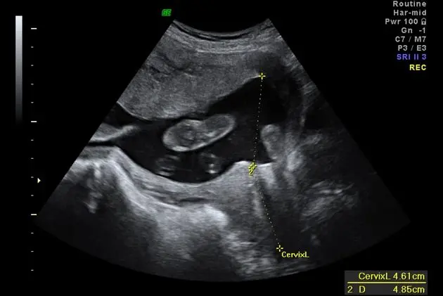 The second ultrasound