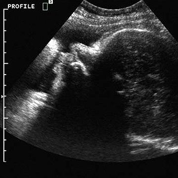 The third ultrasound – Healthy Food Near Me