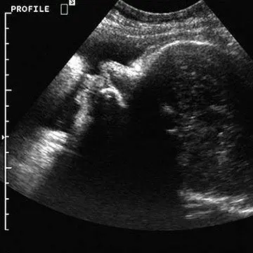 The third ultrasound