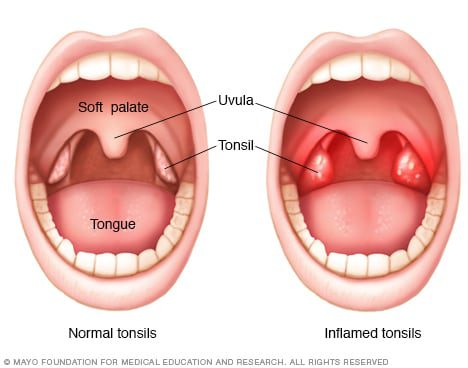 Tonsils in children