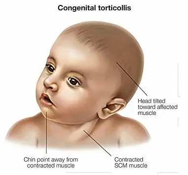 Torticollis in children