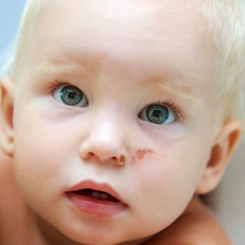 Zdravite dojenčkove rane in izbokline