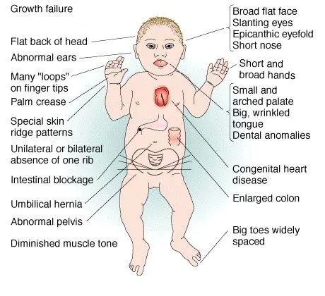 Trisomy 21: screening, signs, treatment, consequences