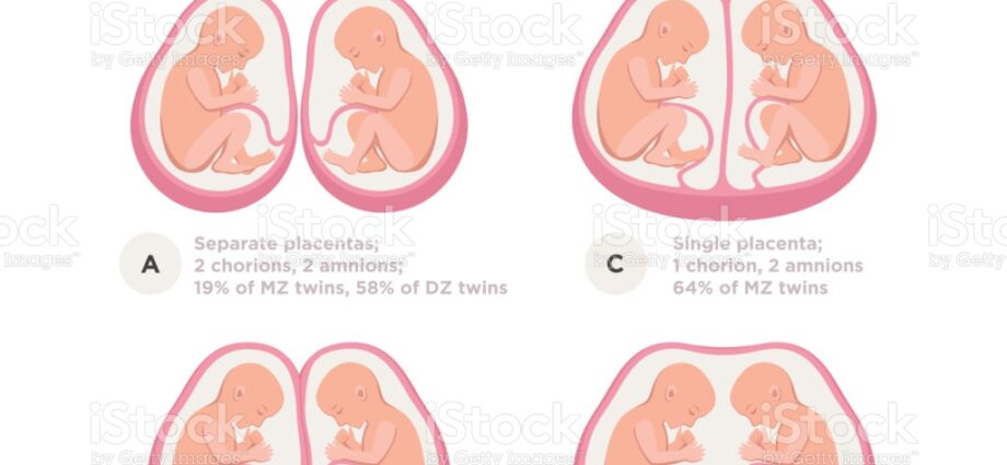 Twin pregnancy: pregnant with twins, what pregnancy follow-up?