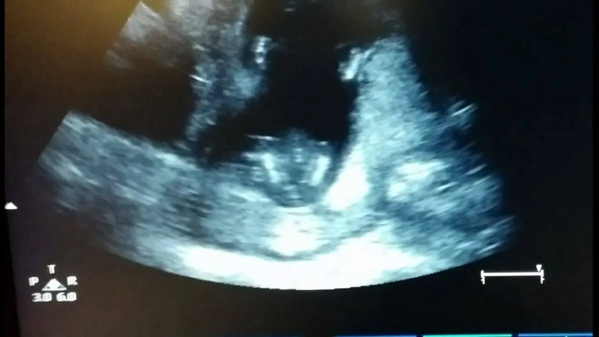 Ultrasound: a fetus applauds in its mother&#8217;s womb