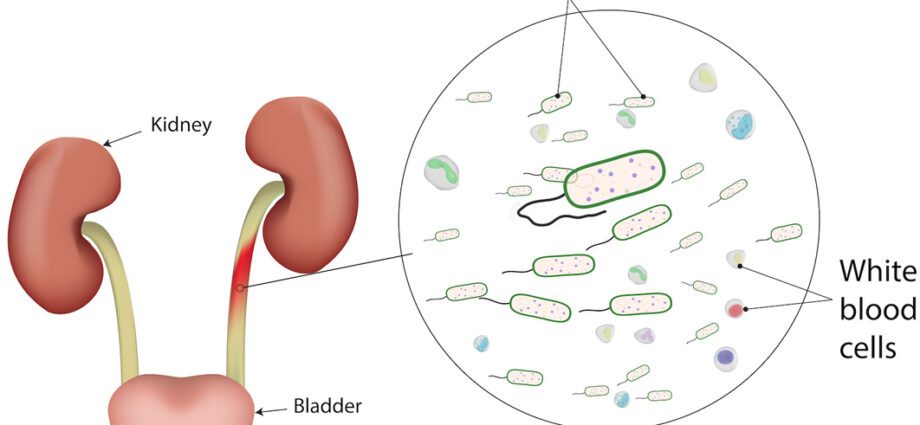 Urinary tract infections: the little ones too