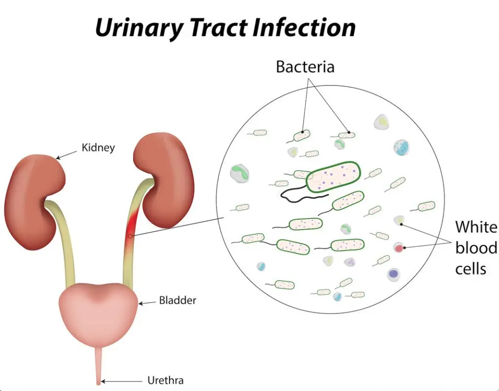 Urinary tract infections: the little ones too