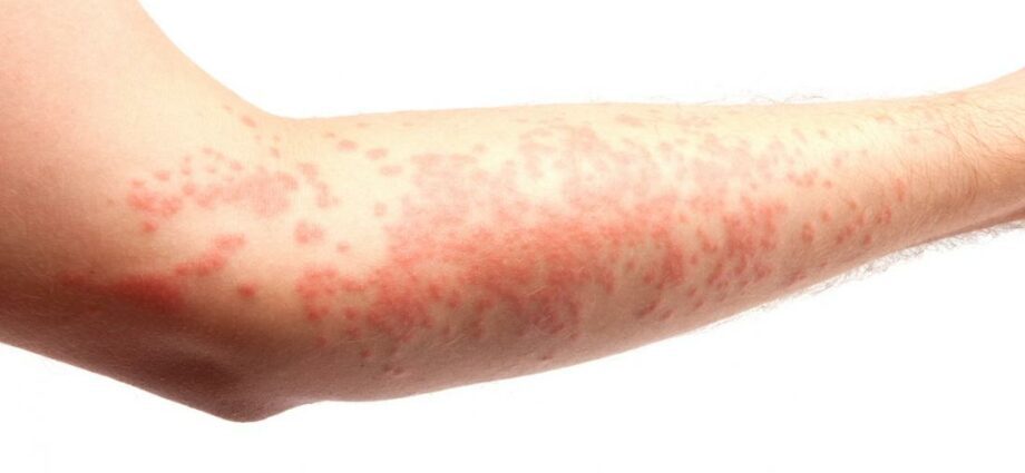 Urticaria: definition, symptoms, treatments &#8230; The point