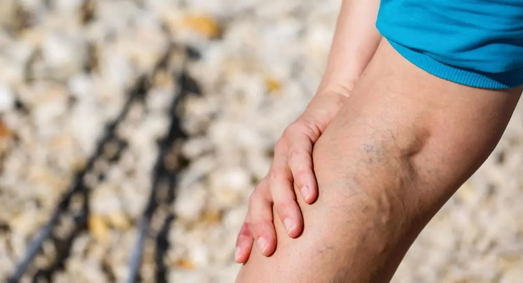 Varicose veins during pregnancy