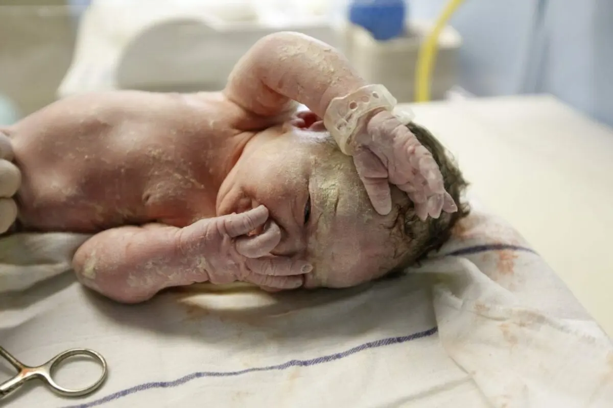 Vernix, what is it?