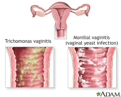Vulvar itching in a little girl