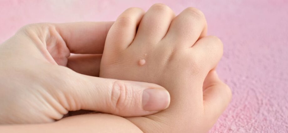 Warts in children