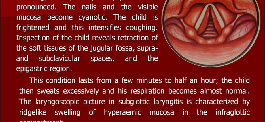 What is false croup and how to treat baby?