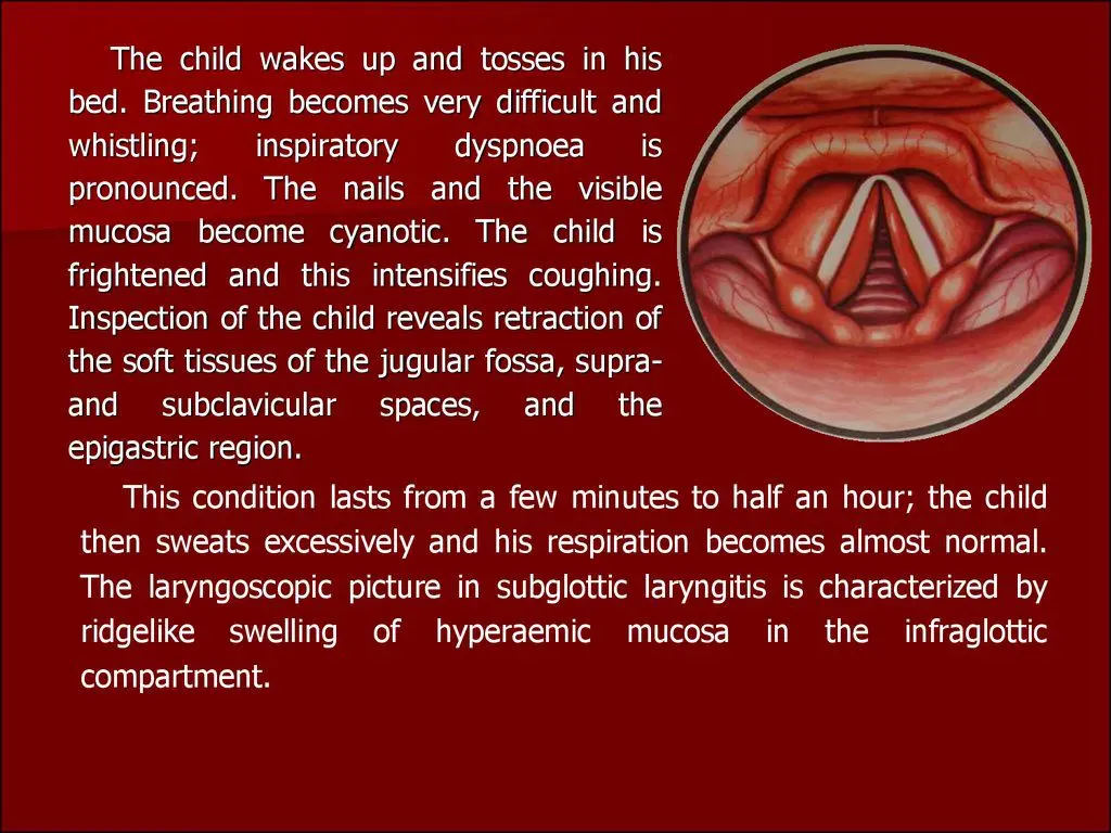 What is false croup and how to treat baby?