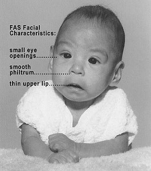 What is Fetal Alcohol Syndrome?