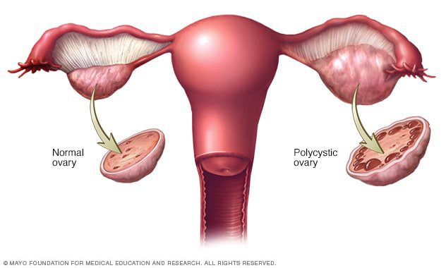 Was ist das polyzystische Ovarialsyndrom (PCOS)?