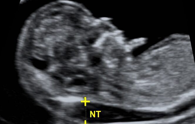 What is the nuchal translucency of the fetus?