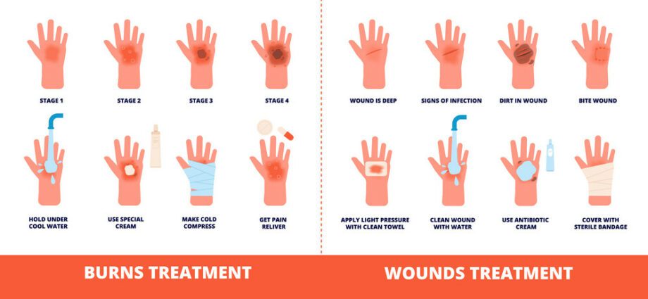 Wounds and burns: first aid measures