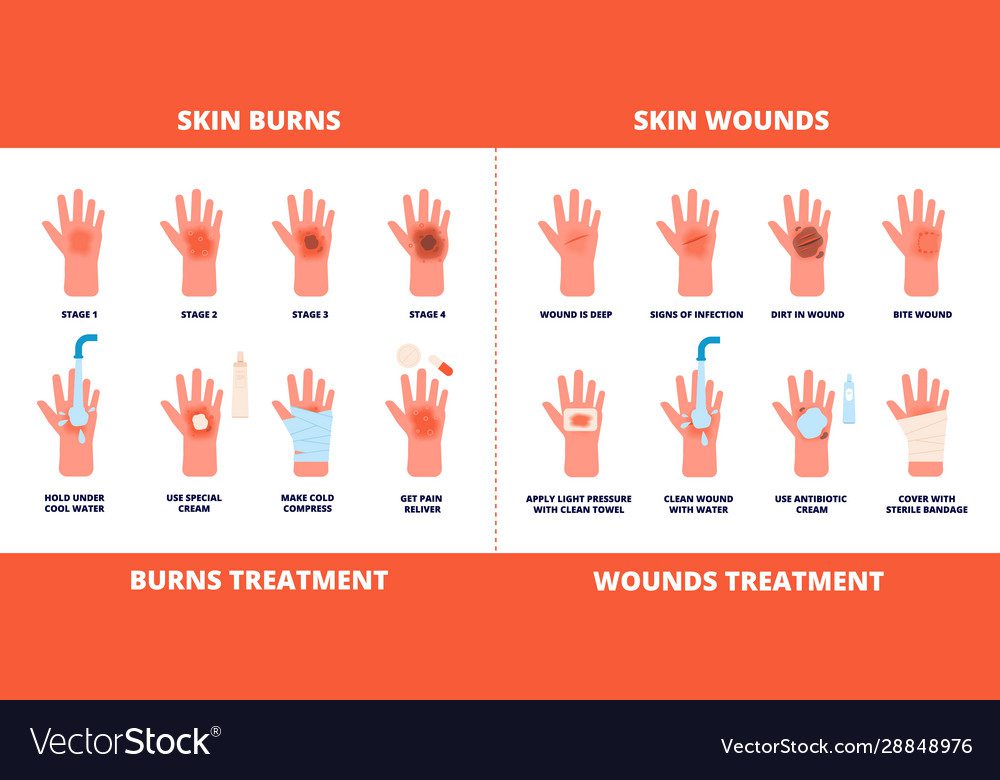 Wounds and burns first aid measures Healthy Food Near Me