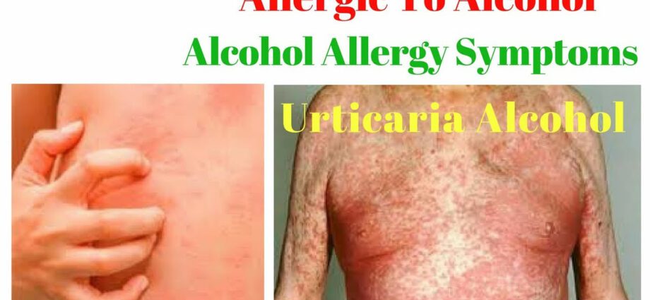 Allergy to alcohol &#8211; symptoms and how to treat