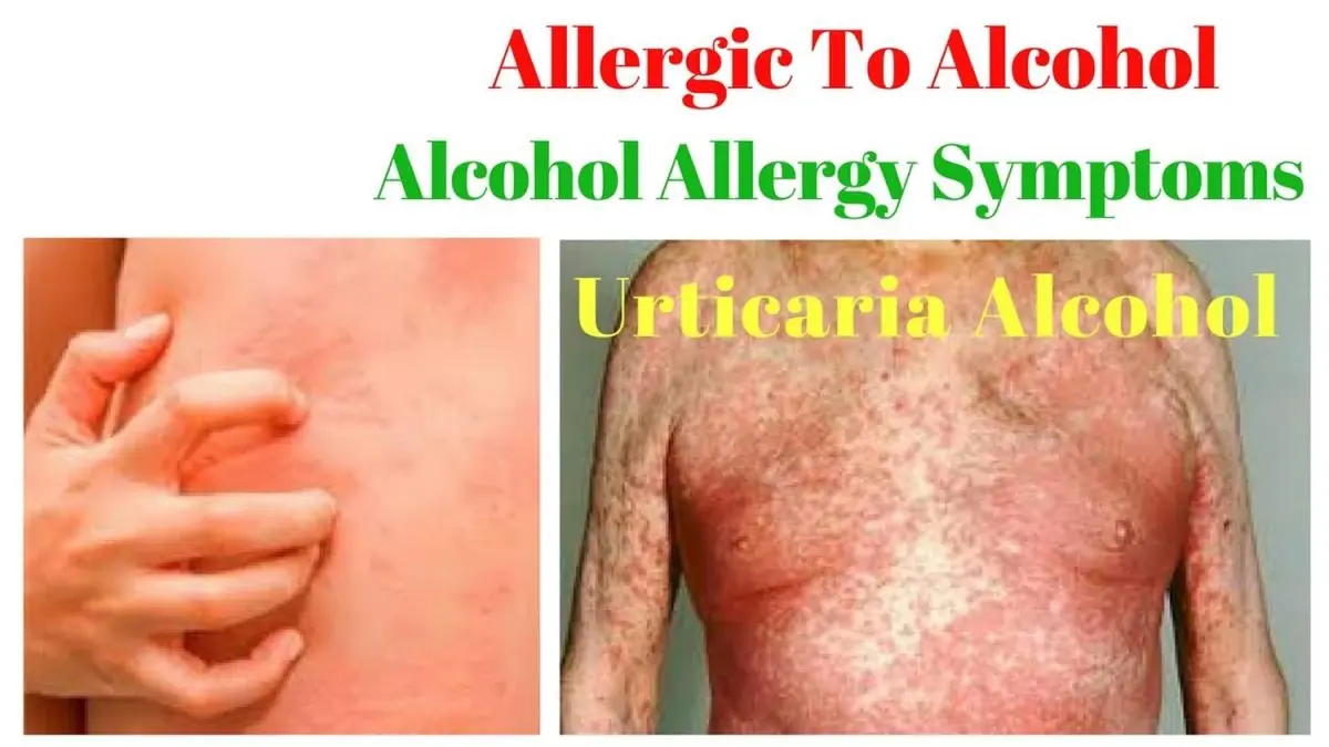 Allergy to alcohol &#8211; symptoms and how to treat
